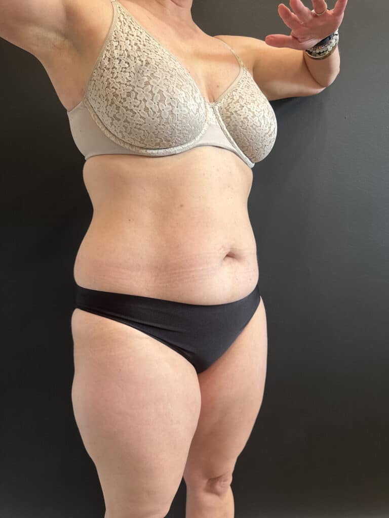 Before Image: Case #9373 – Emsculpt Neo - right-front-oblique
