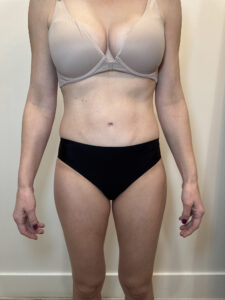 After Image: Case #9378 – Body Contour, Emsculpt Neo
