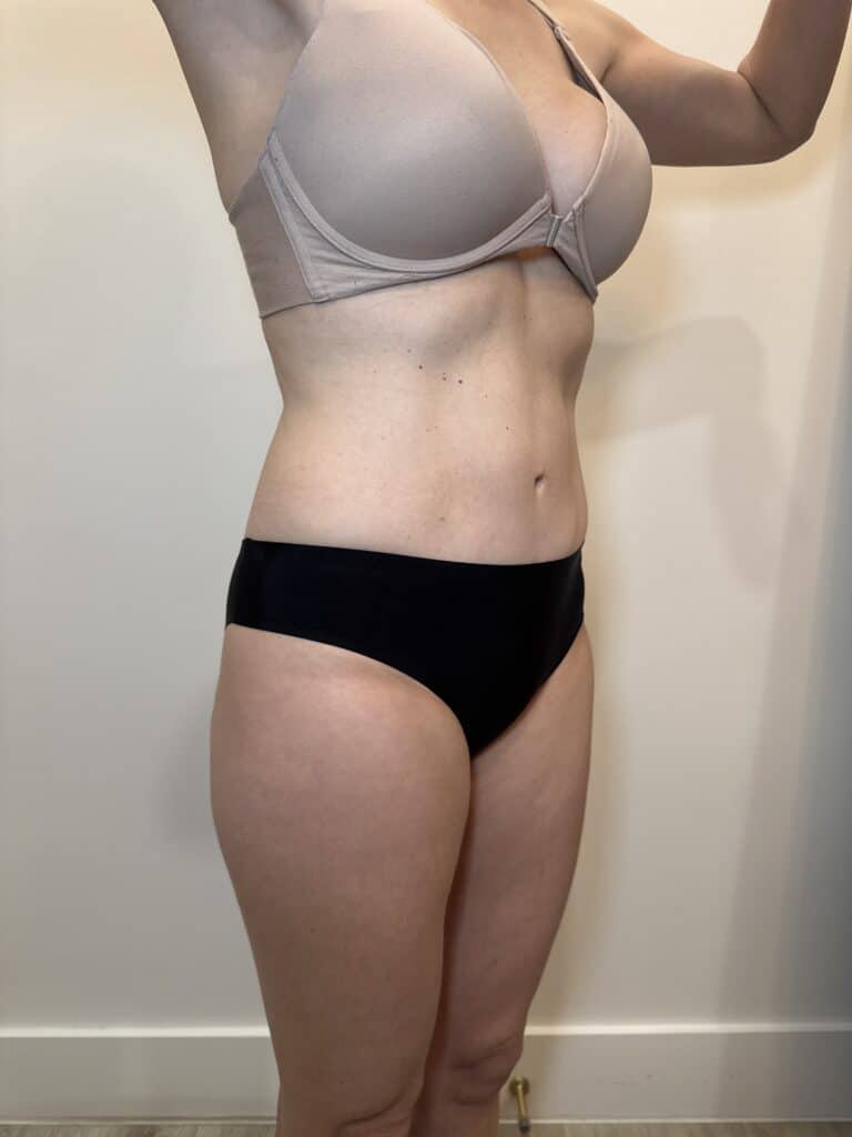 After Image: Case #9378 – Body Contour, Emsculpt Neo - right-front-oblique