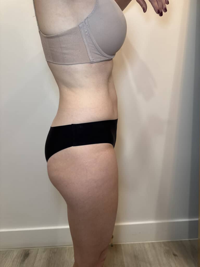 After Image: Case #9378 – Body Contour, Emsculpt Neo - right-side