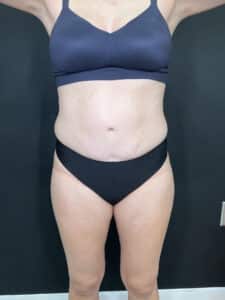 Before Image: Case #9378 – Body Contour, Emsculpt Neo