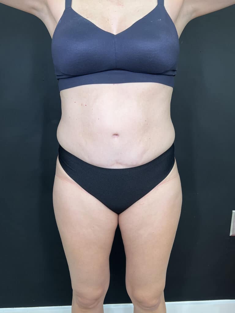 Before Image: Case #9378 – Body Contour, Emsculpt Neo - front