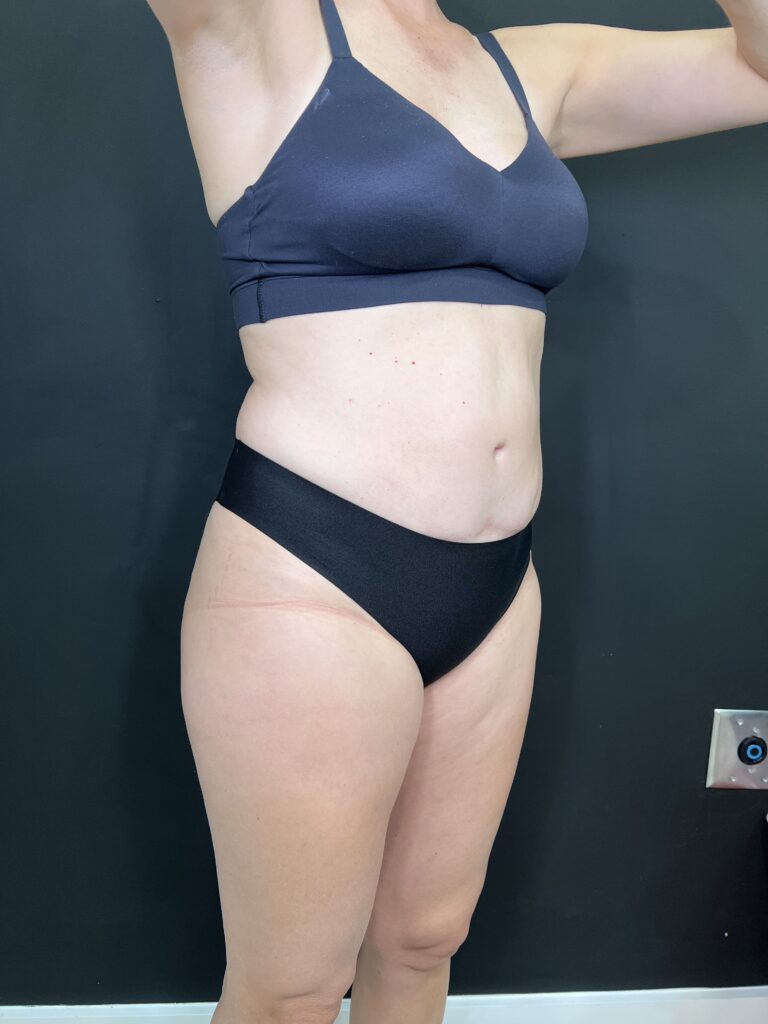 Before Image: Case #9378 – Body Contour, Emsculpt Neo - right-front-oblique