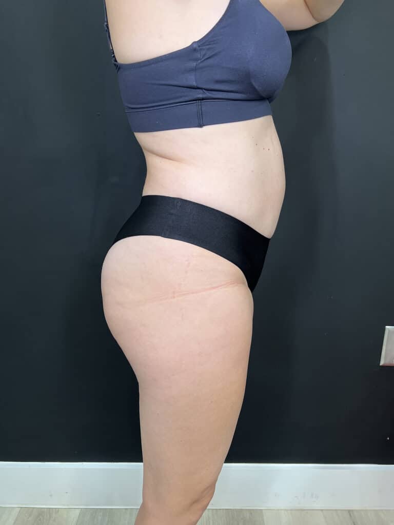 Before Image: Case #9378 – Body Contour, Emsculpt Neo - right-side