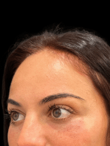 After Image: Case #9367 – Mid Cheek and Tear Trough Filler by Katelyn Gross BSN, RN