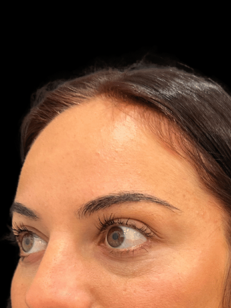 Before Image: Case #9367 – Mid Cheek and Tear Trough Filler by Katelyn Gross BSN, RN - left-front-oblique