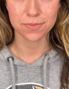 After Image: Case #9370 – Chin filler for facial balancing by Katelyn Gross BSN, RN
