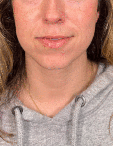 Before Image: Case #9370 – Chin filler for facial balancing by Katelyn Gross BSN, RN
