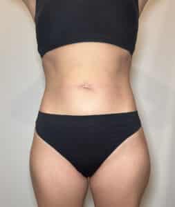 After Image: Case #9392 – Emsculpt Neo