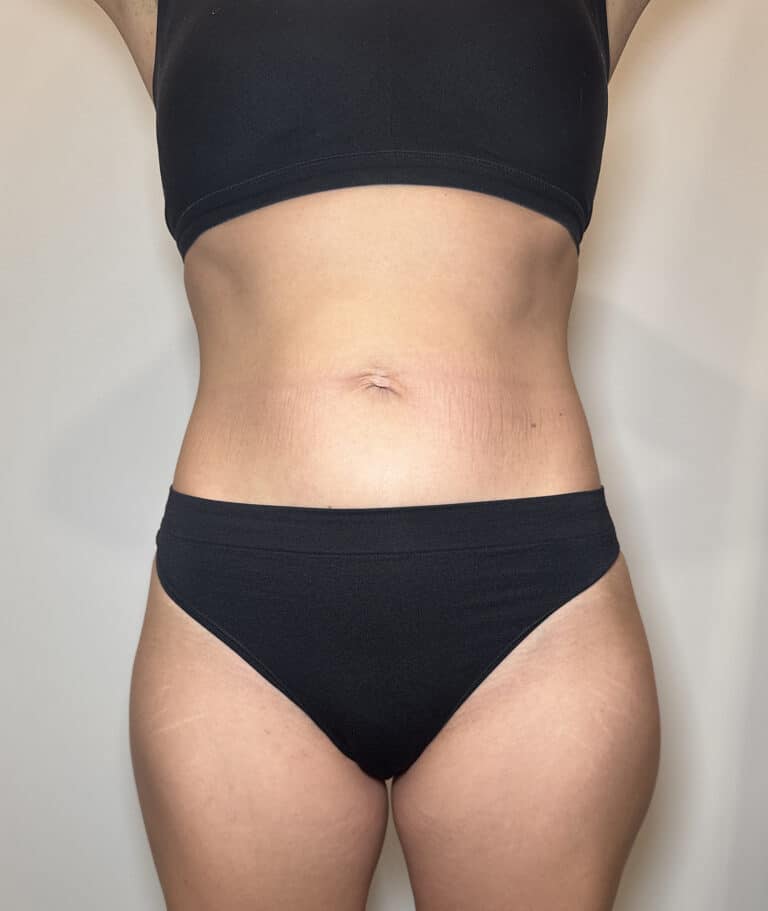 After Image: Case #9392 – Emsculpt Neo - front