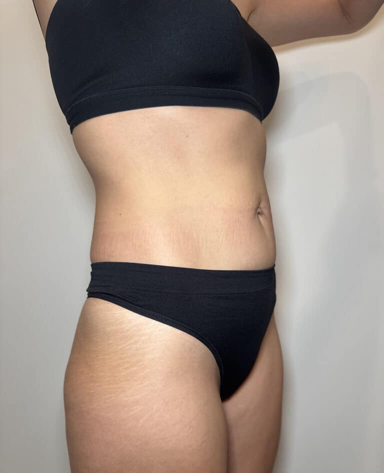 After Image: Case #9392 – Emsculpt Neo - right-front-oblique