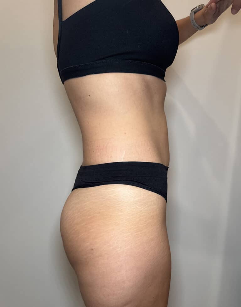 After Image: Case #9392 – Emsculpt Neo - right-side