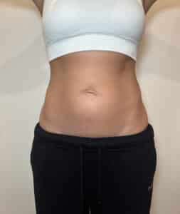 Before Image: Case #9392 – Emsculpt Neo