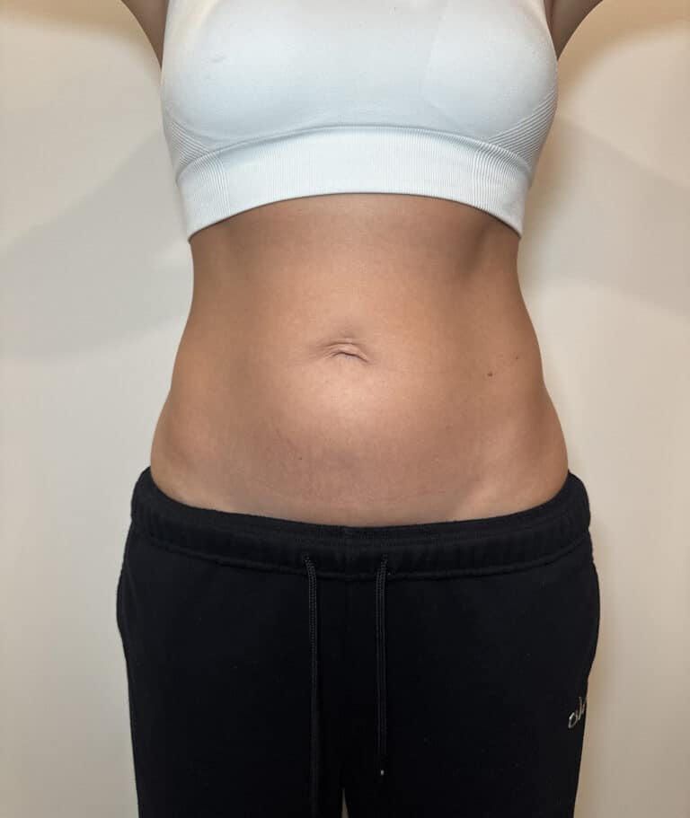 Before Image: Case #9392 – Emsculpt Neo - front
