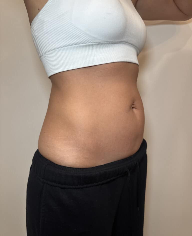 Before Image: Case #9392 – Emsculpt Neo - right-front-oblique