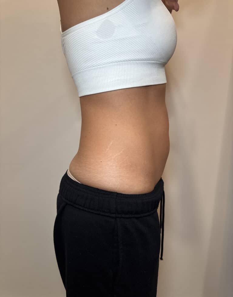 Before Image: Case #9392 – Emsculpt Neo - right-side