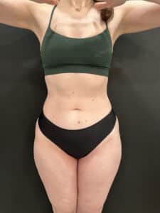 After Image: Case #9401 – Emsculpt Neo