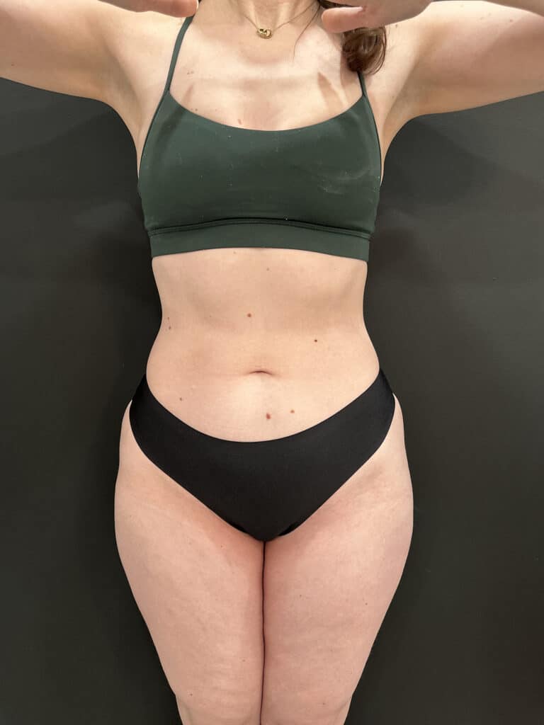 After Image: Case #9401 – Emsculpt Neo - front