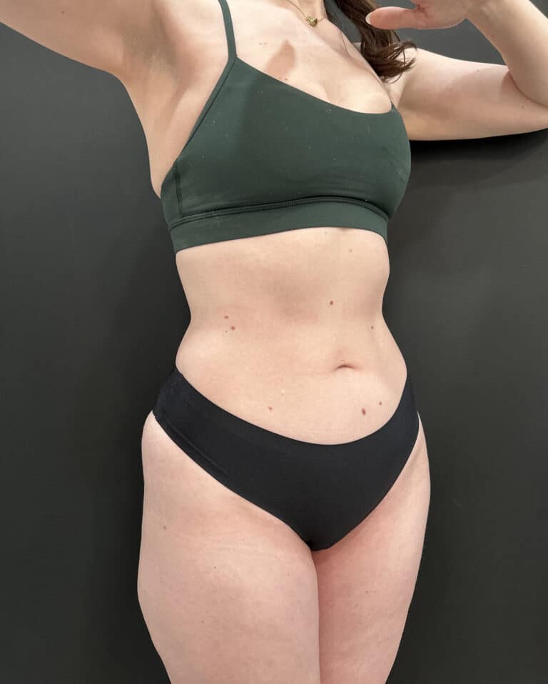 After Image: Case #9401 – Emsculpt Neo - right-front-oblique