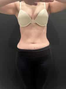 Before Image: Case #9401 – Emsculpt Neo