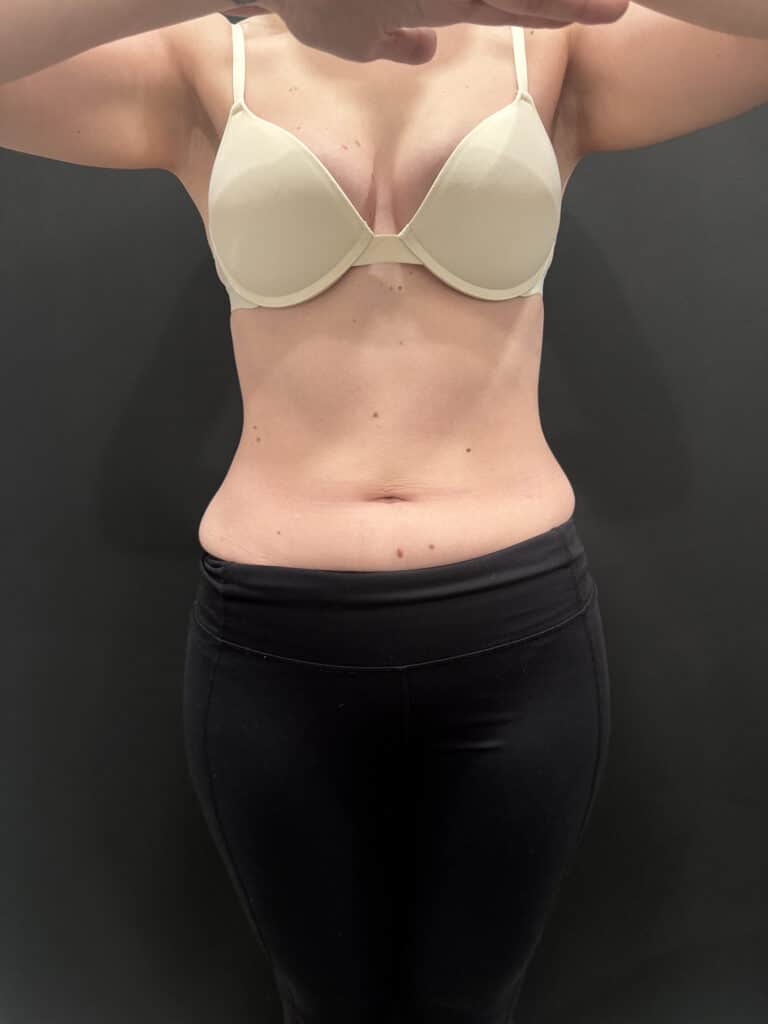 Before Image: Case #9401 – Emsculpt Neo - front