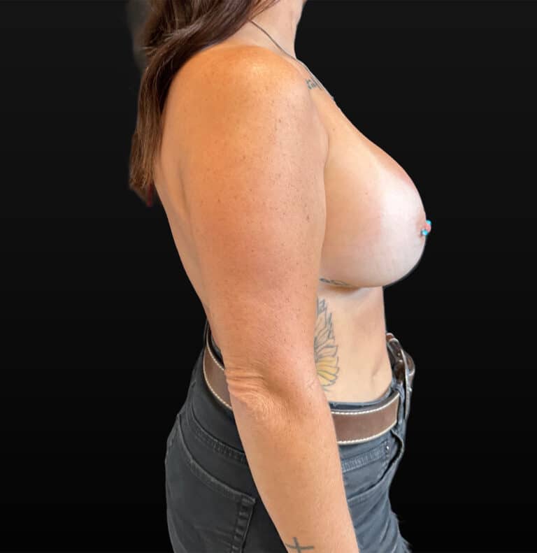 After Image: Case #9421 – Breast Augmentation - right-side