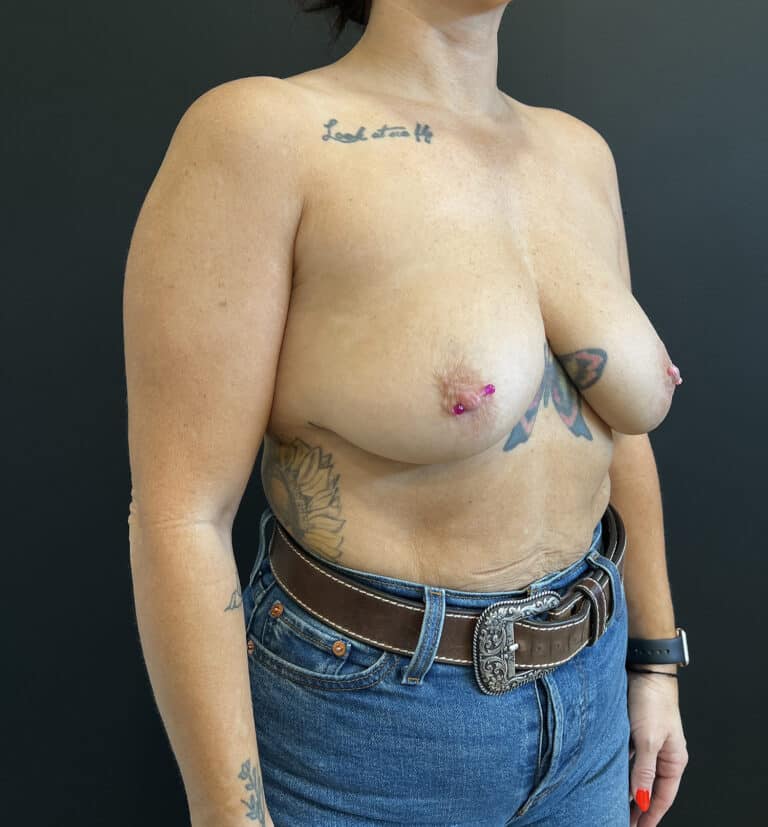 Before Image: Case #9421 – Breast Augmentation - right-front-oblique