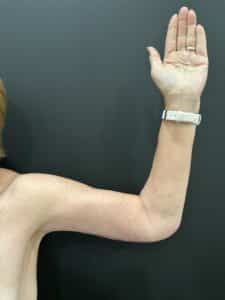 After Image: Case #9435 – Extended Arm lift (Brachioplasty)