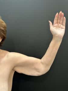 Before Image: Case #9435 – Extended Arm lift (Brachioplasty)