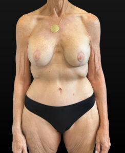 After Image: Case #9458 – Mommy Makeover