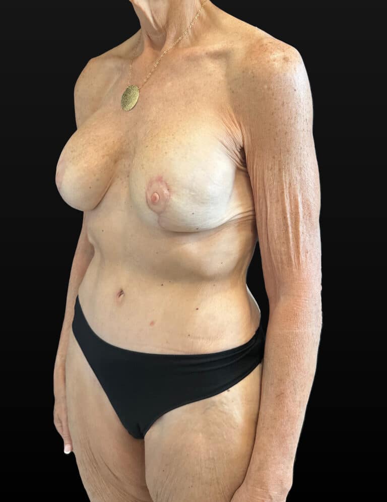 After Image: Case #9458 – Mommy Makeover - left-front-oblique