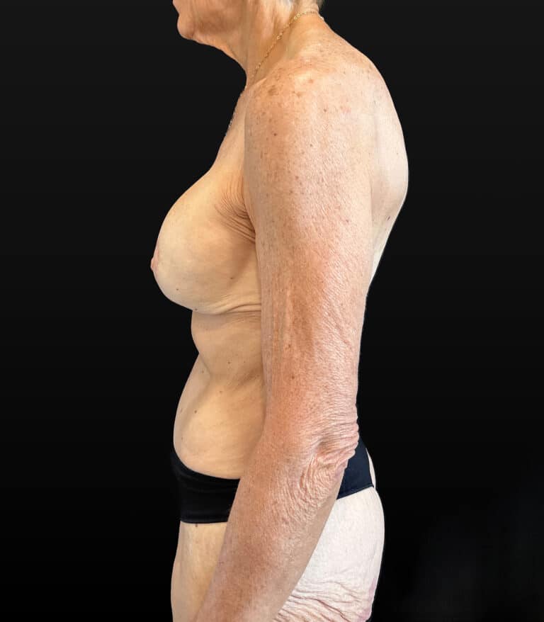After Image: Case #9458 – Mommy Makeover - left-side