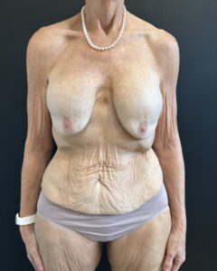 Before Image: Case #9458 – Mommy Makeover