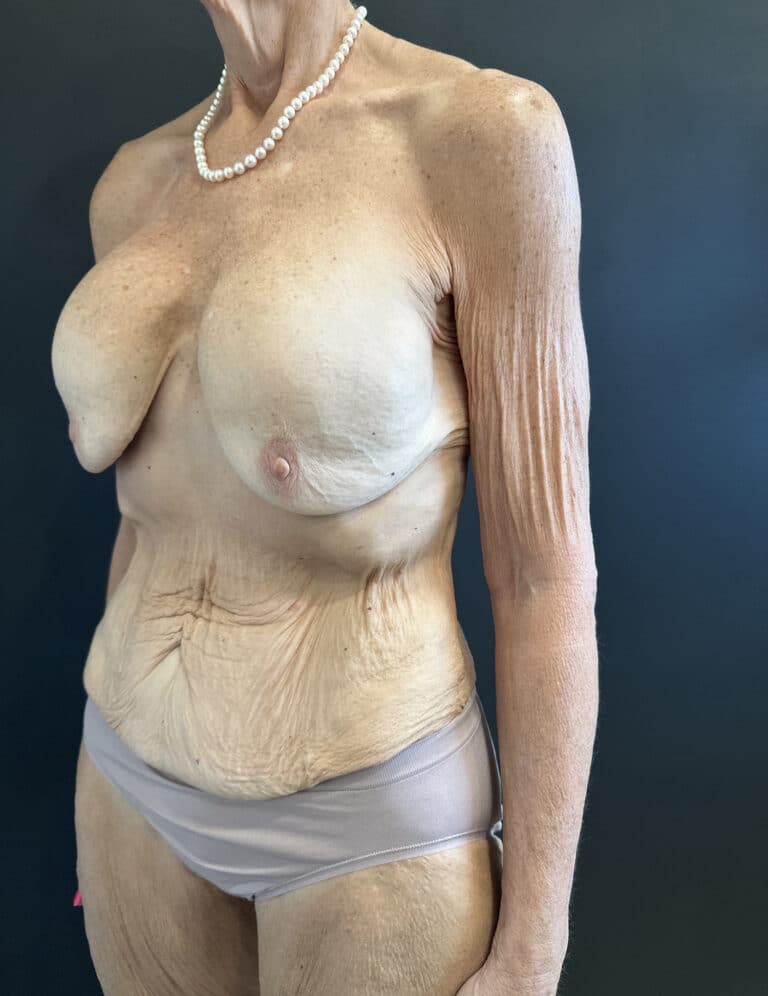 Before Image: Case #9458 – Mommy Makeover - left-front-oblique
