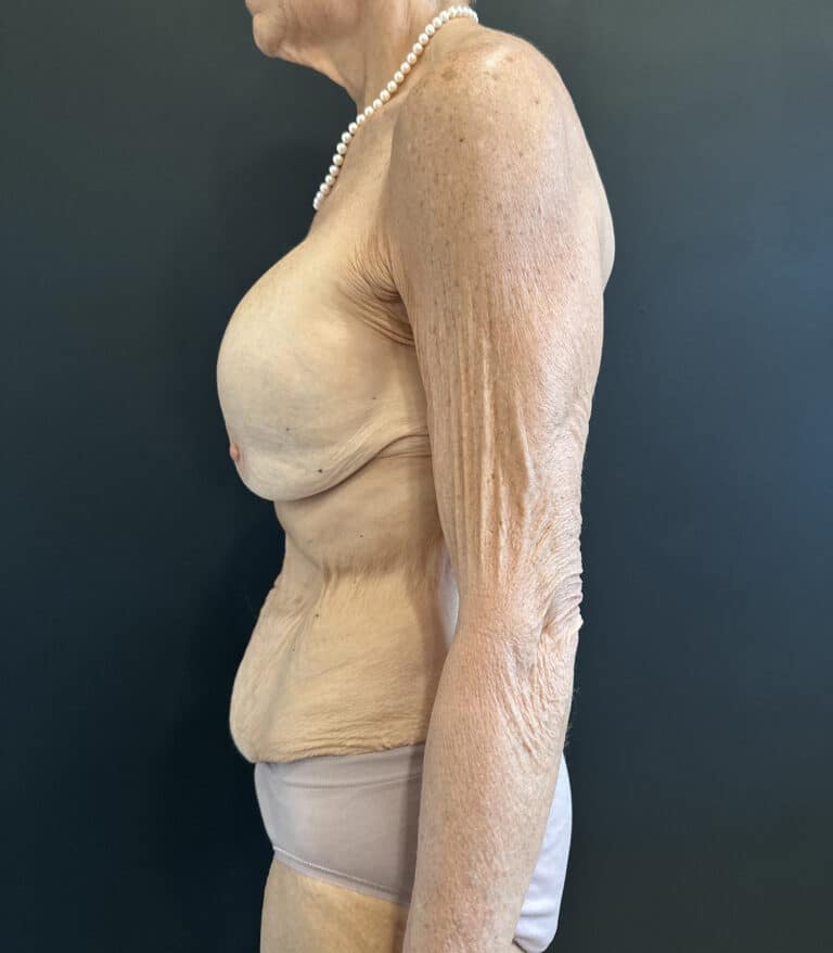 Before Image: Case #9458 – Mommy Makeover - left-side