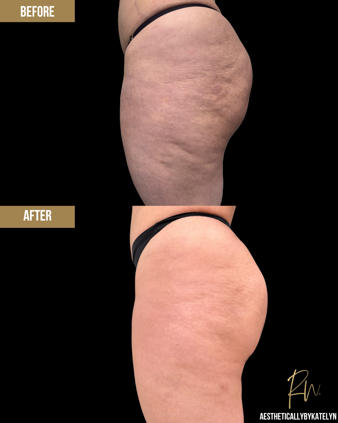 Aveli Before and After