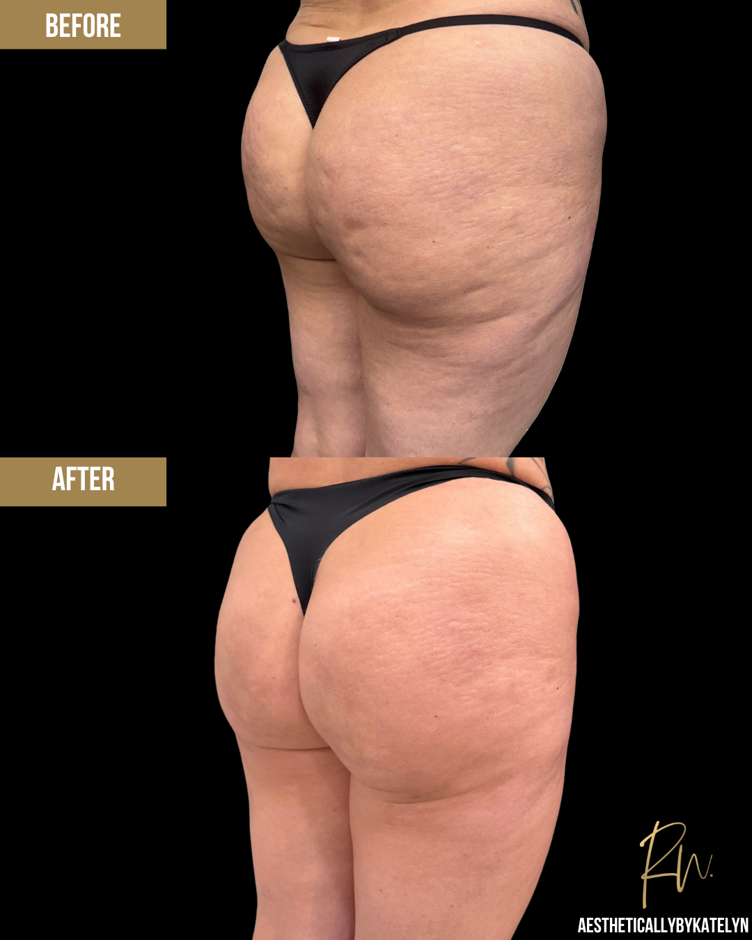 Aveli Before and After