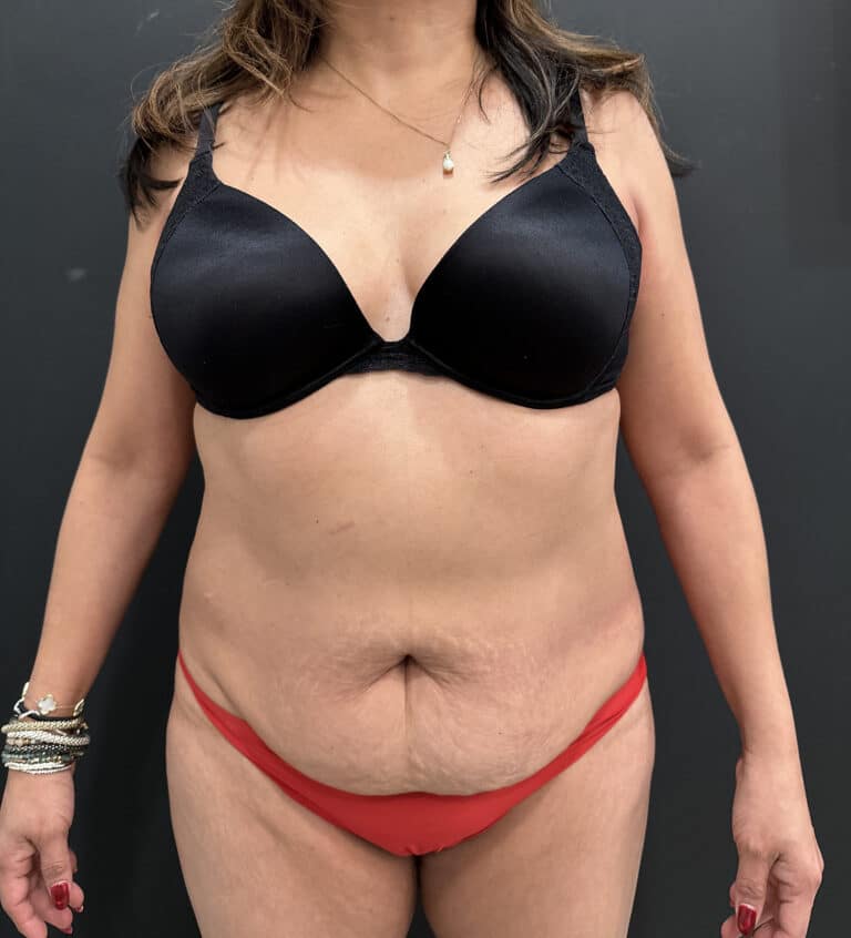 Before Image: Case #9510 – Abdominoplasty with Safelipo of Circ Trunk - front