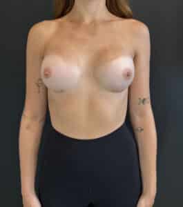 After Image: Case #9521 – Breast Augmentation