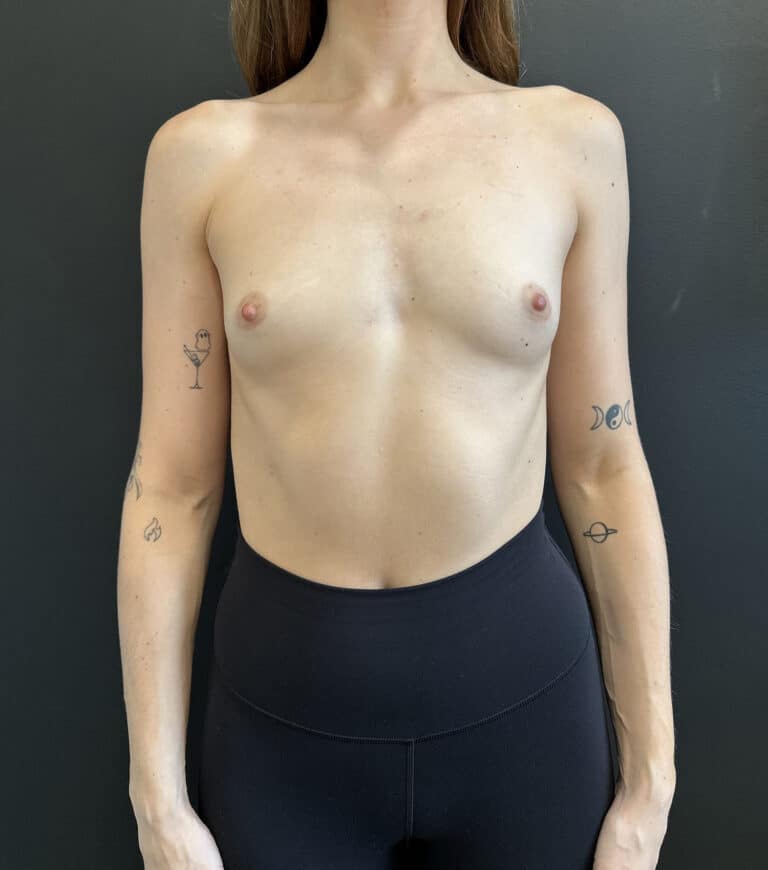 Before Image: Case #9521 – Breast Augmentation - front