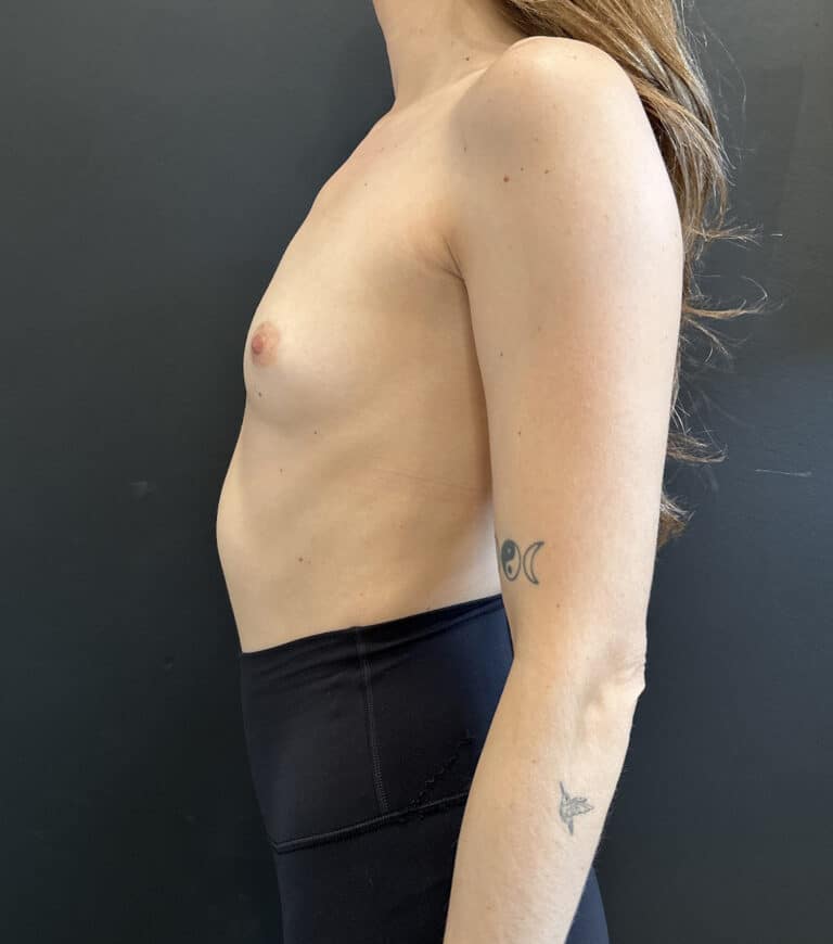 Before Image: Case #9521 – Breast Augmentation - left-side