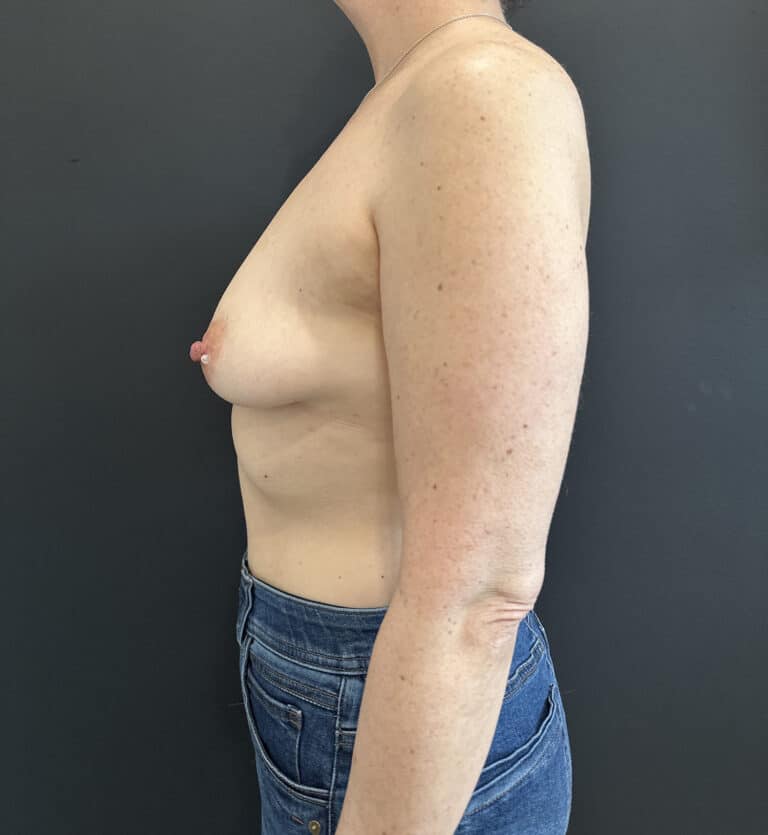Before Image: Case #9528 – Breast Augmentation - left-side