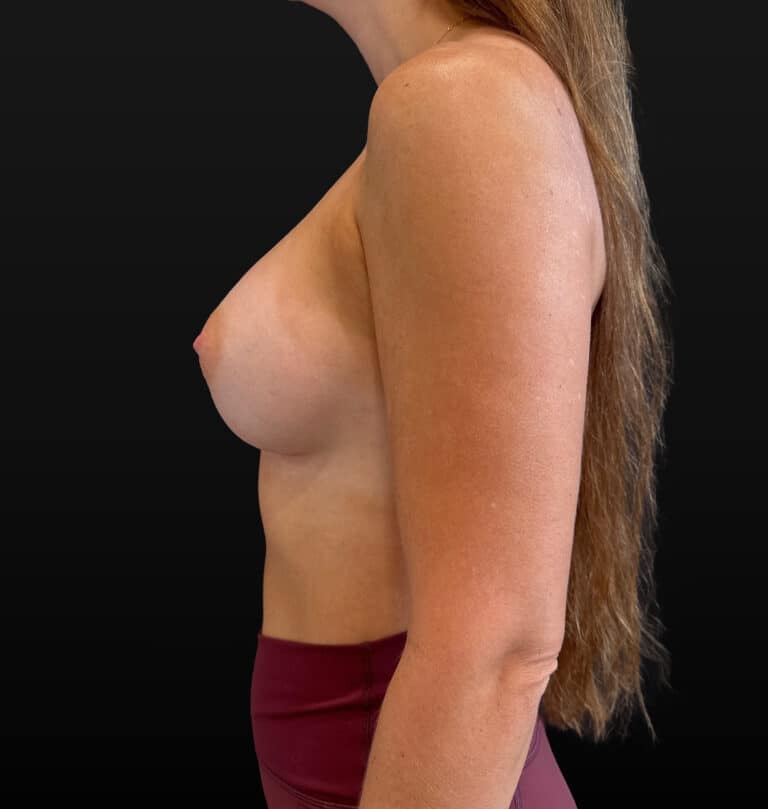 After Image: Case #9535 – Breast Augmentation - left-side