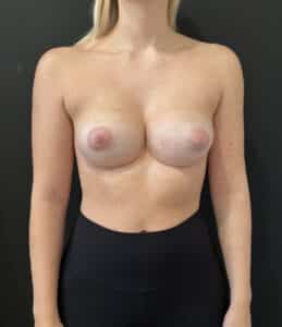 After Image: Case #9555 – Revision Breast Implant Exchange