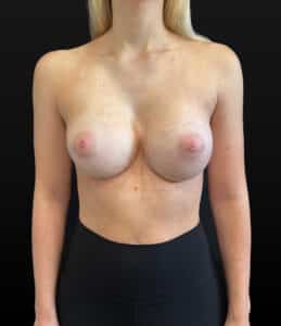 Before Image: Case #9555 – Revision Breast Implant Exchange