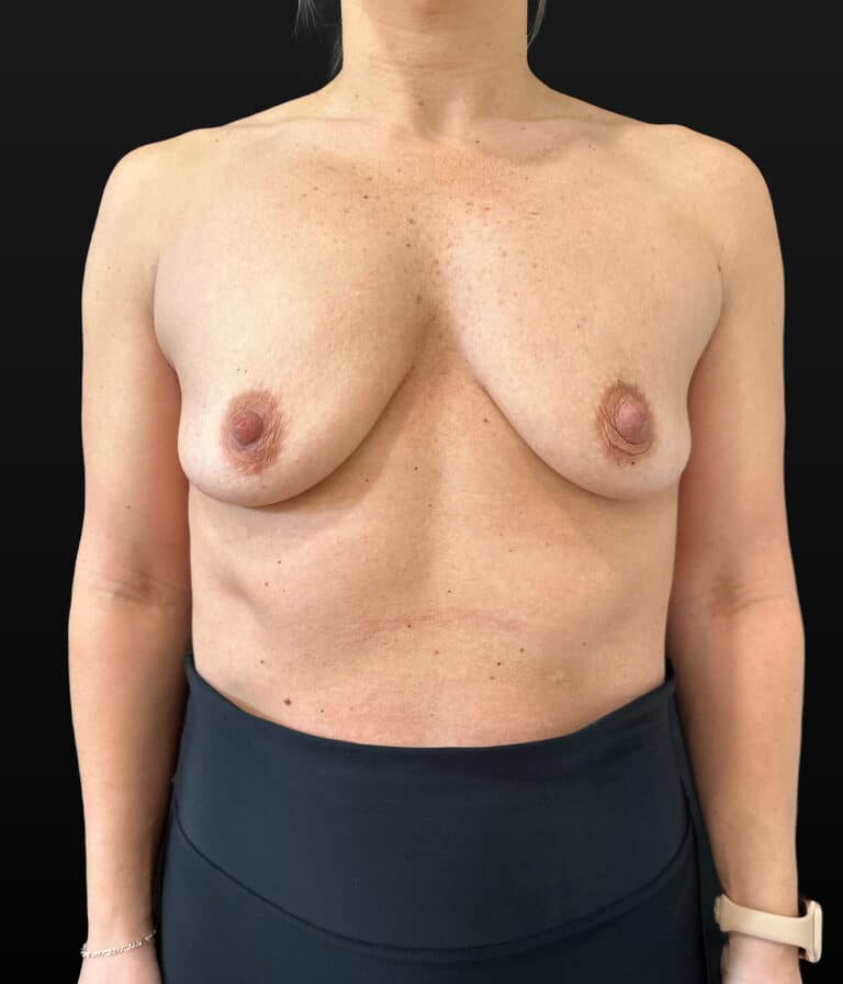 Before Image: Case #9563 – Breast Augmentation - front
