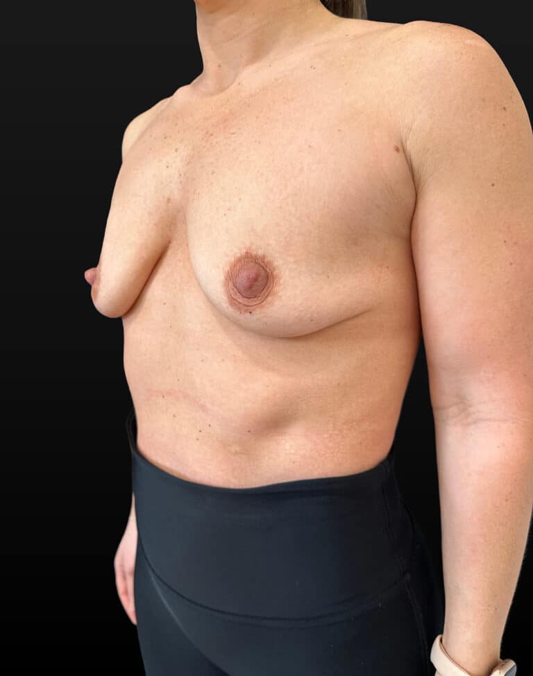 Before Image: Case #9563 – Breast Augmentation - left-front-oblique