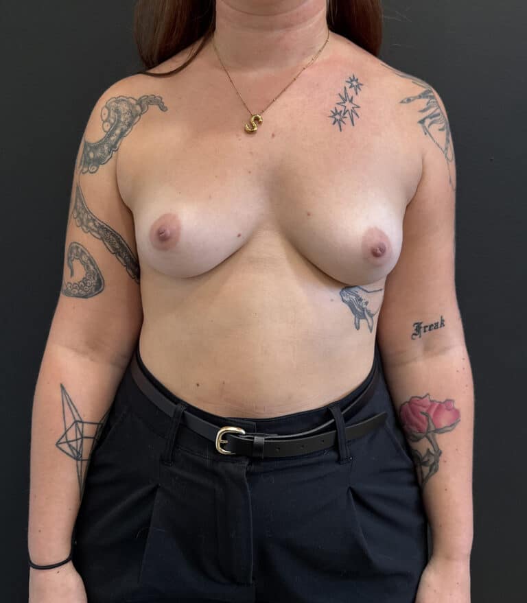 Before Image: Case #9574 – Breast Augmentation - front