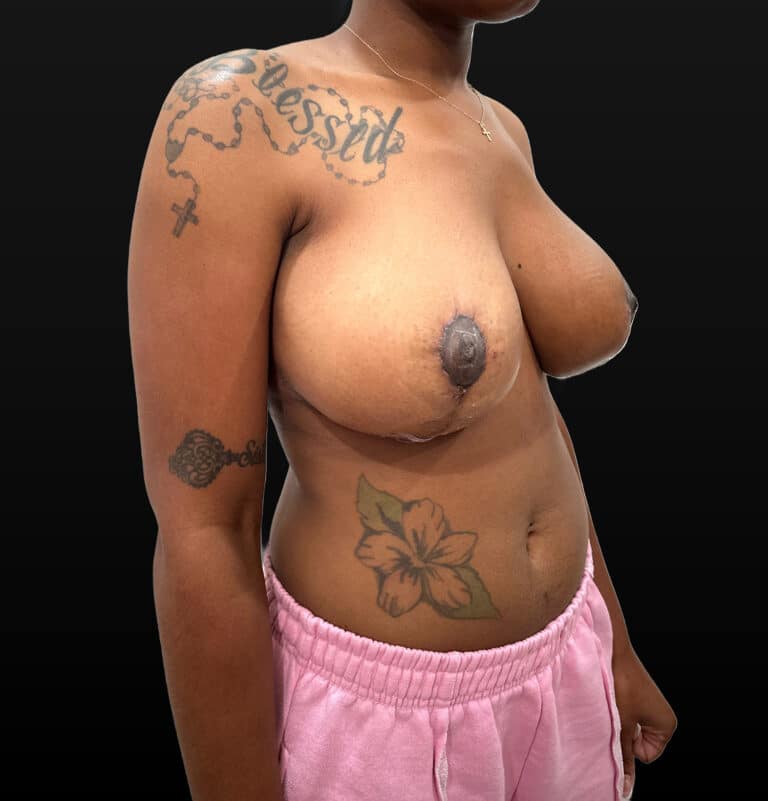 After Image: Case #9579 – Breast Reduction - right-front-oblique