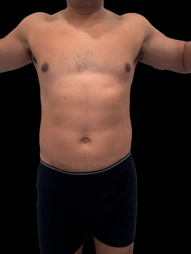 After Image: Case #9599 – Emsculpt Neo Abdomen - front